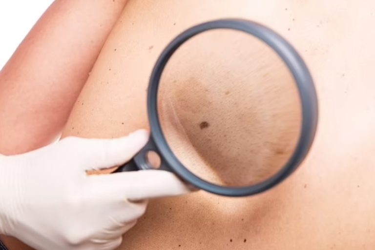 Công nghệ mới trên điện thoại 6G có thể giúp phát hiện sớm ung thư da